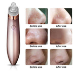 Blackhead Vacuum Pore  Cleaner , Acne Pimple Remover